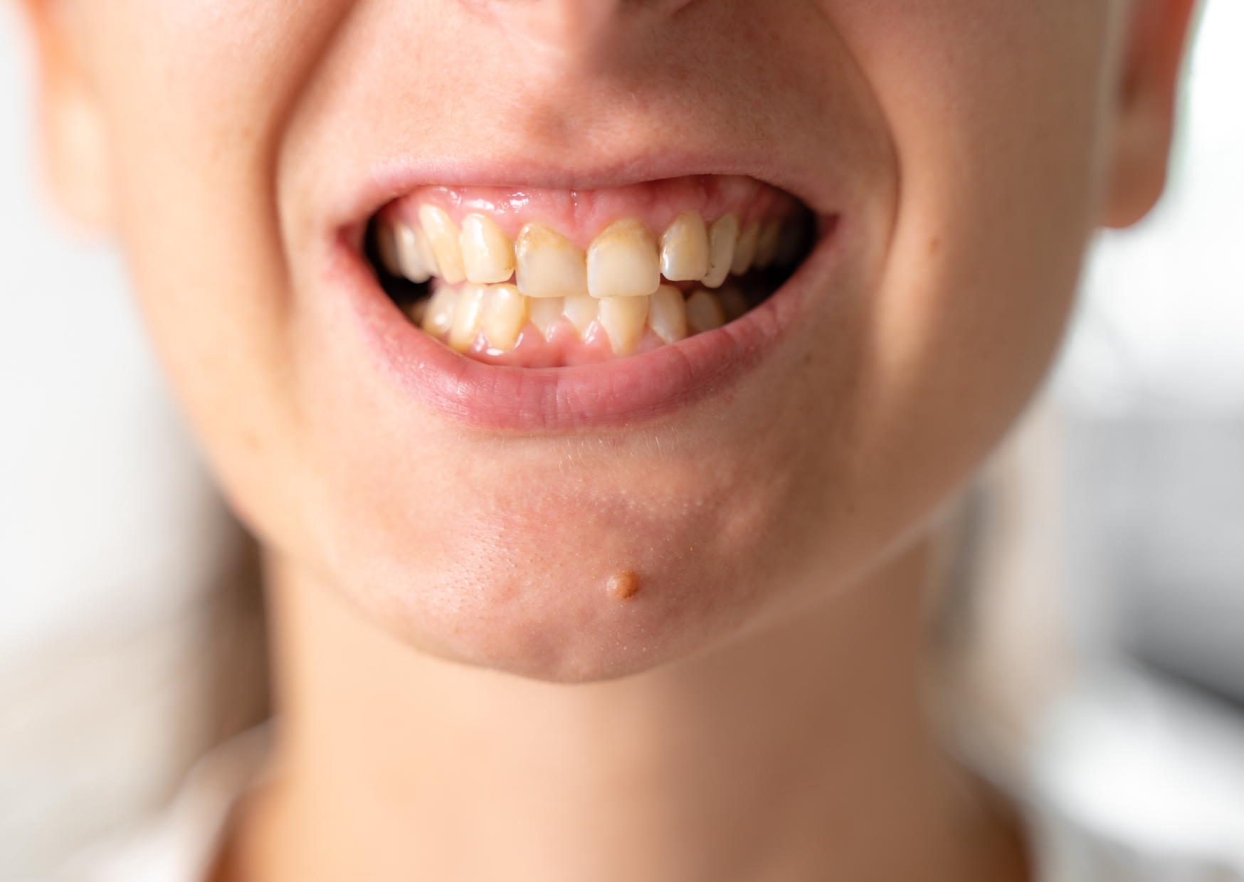 The British Teeth Americans Spend $50,000 to “Fix” That Work Fine 1 british teeth 2