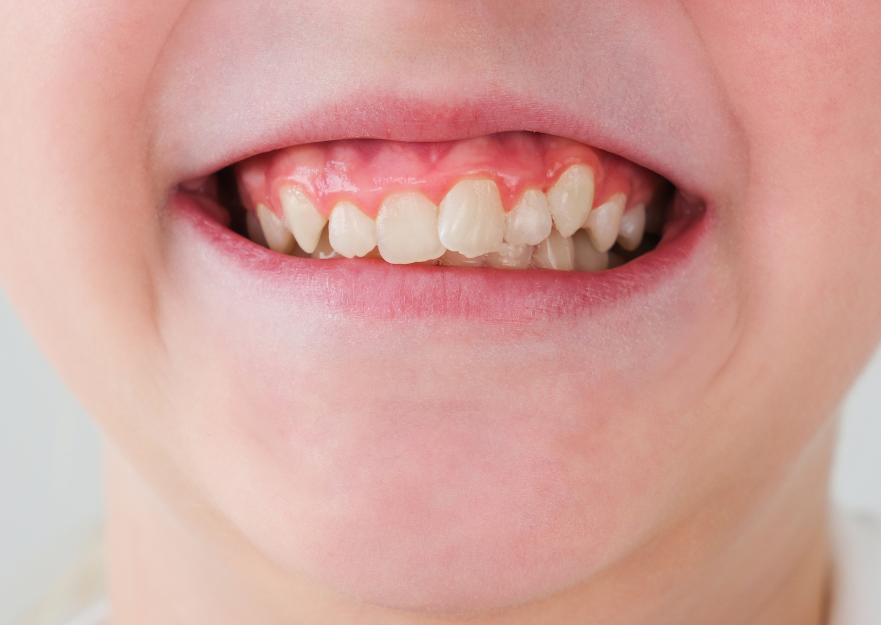 The British Teeth Americans Spend $50,000 to “Fix” That Work Fine 2 british teeth 3