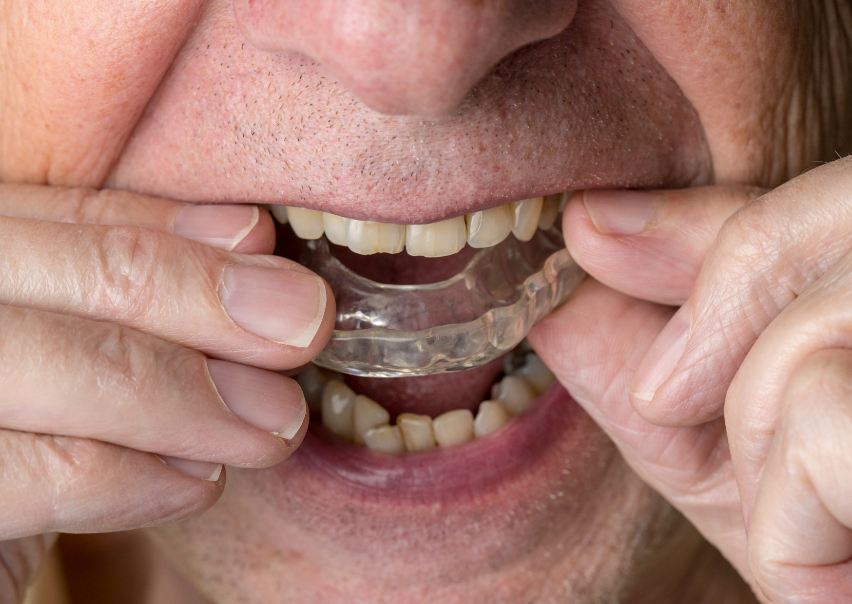 The British Teeth Americans Spend $50,000 to “Fix” That Work Fine 6 british teeth 5