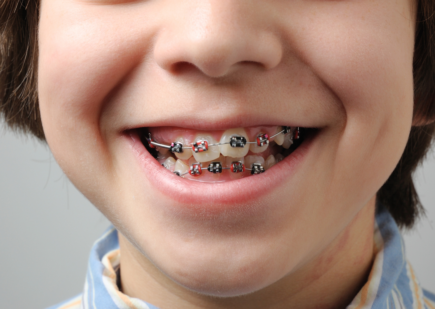 The British Teeth Americans Spend $50,000 to “Fix” That Work Fine 4 british teeth 6