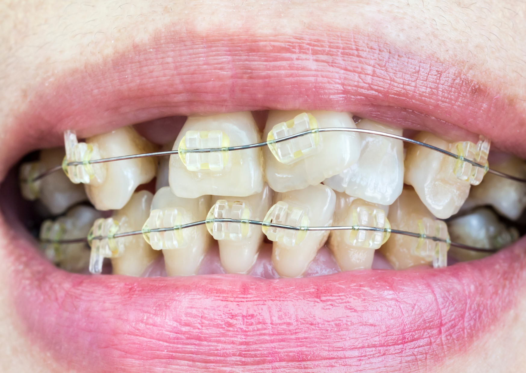 The British Teeth Americans Spend $50,000 to “Fix” That Work Fine 7 british teeth 7