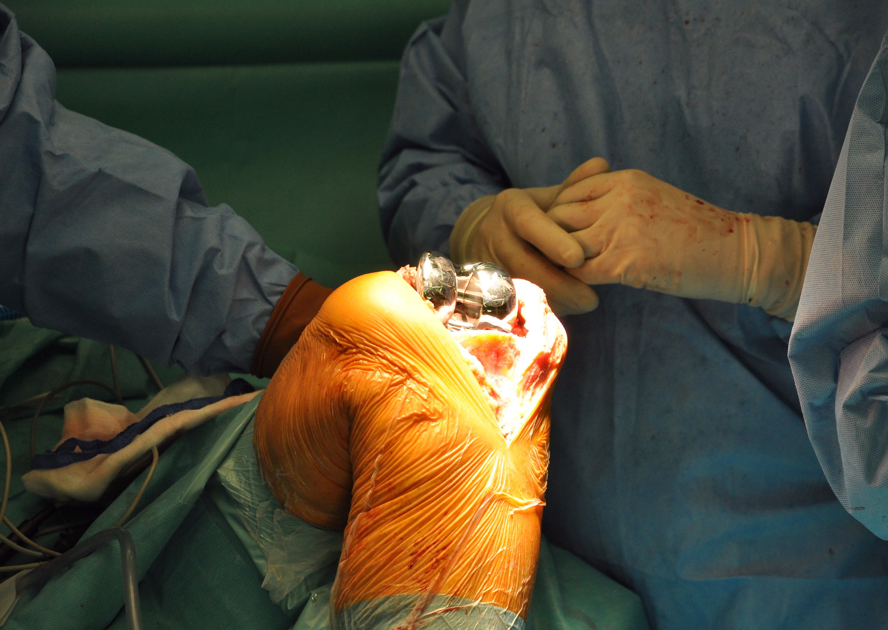 Knee Replacement 4